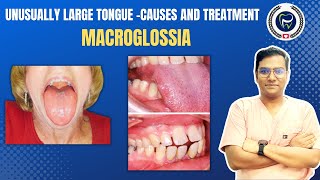 Dr Rudra Mohan  Macroglossia  Enlarged Tongue  Understand Causes and Treatment Options [upl. by Kingston]