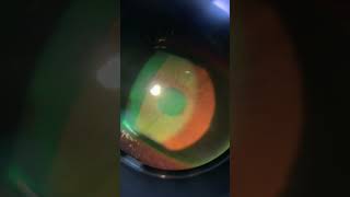 Inflação da cornea Ceratite [upl. by Ebocaj]