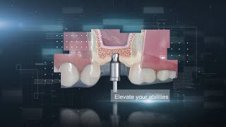 BSB Sinus Lift Marketing Video [upl. by Roslyn]