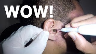 Mans Earwax Buildup Removal with Hydrogen Peroxide Application [upl. by Tuck]