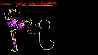 Oncologic Emergencies Tumor Lysis Syndrome [upl. by Leonie]