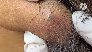 sebaceous cyst behind the neck HoangMySpa78 [upl. by Aramit]