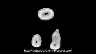 Maxillary First Molar MB2 Prof Marco Versiani [upl. by Bathsheeb]