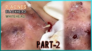 Big Cystic Acne Blackheads Extraction Blackheads amp Milia Whiteheads Removal Pimple Popping [upl. by Kara364]