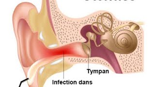 📍Pathologies de loreille externe 🔥 [upl. by Rosenstein]