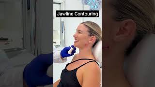 Jawline contouring using fillers [upl. by Ecarg]