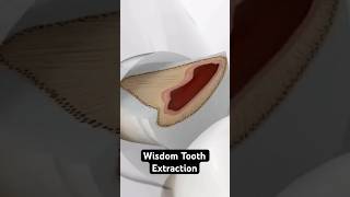 Wisdom Tooth Extraction 3D Animation [upl. by Litnahs]