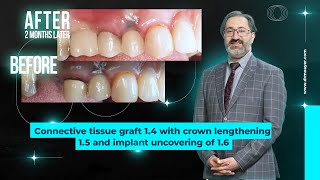 Connective tissue graft 14 with crown lengthening 15 and implant uncovering of 16 [upl. by Tunnell]