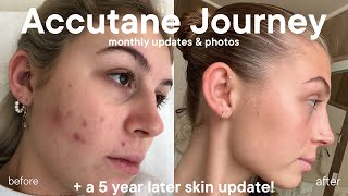 My Accutane Journey monthly updates progress pictures and a 5 year skin update [upl. by Aelahs]