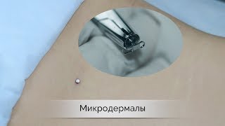 Микродермал – установка  пирсинг Самара влог  microdermal piercing [upl. by Isayg542]