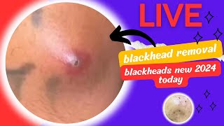 Blackheads new 2024 today blackhead removal blackhead extraction [upl. by Randy]