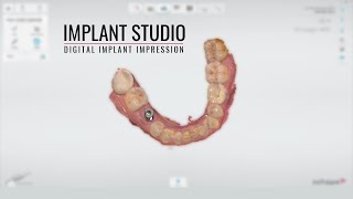 3Shape Trios Implant Impression [upl. by Joelynn]