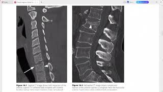 CLINICAL IMAGING OF SPINAL TRAUMA [upl. by Oiziruam]