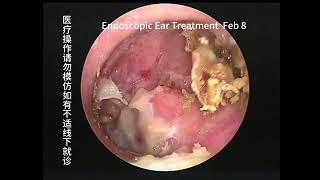 Two cases of cholesteatoma with significant differences [upl. by Viridissa]