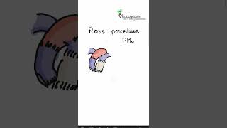 Ross procedure mnemonic for congenital cardiology  Aortic autograft and pulmonary homograft [upl. by Atiluap606]