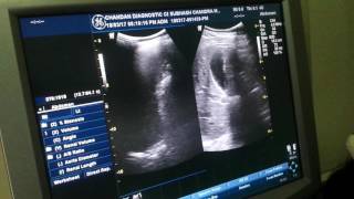 Chronic cystitis Ultrasound [upl. by Siron]