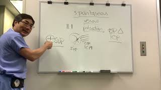 Spontanous venous pulsation in papilledema [upl. by Torie]