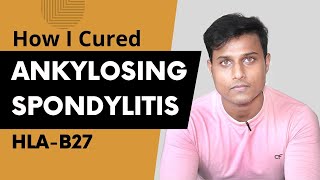 How I Cured My Ankylosing Spondylitis  Ayurvedic Treatment [upl. by Okikuy]