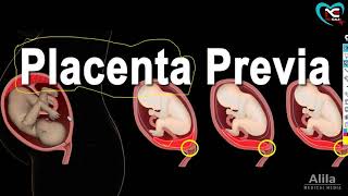 Placenta Previa Definition Cause Type Sign SymptomsFull Explanation in Hindi  By NG Medicals [upl. by Mond751]