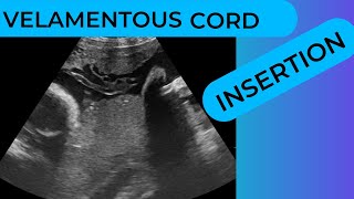 Velamentous Cord Insertion on Ultrasound Scan [upl. by Nahc]