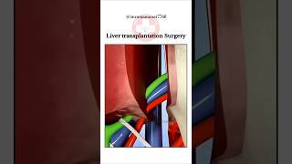 Liver Transplant Surgery LTS shorts medico [upl. by Rapsac498]