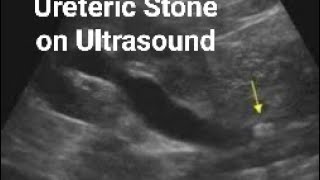 Ureteric stone on Ultrasound [upl. by Irneh566]