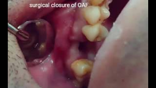 Closure of OAF using membrane [upl. by Olia]