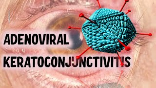 VIRAL CONJUNCTIVITIS  Ultimate Guide to Recognising Clinical Presentations [upl. by Ahseyt]