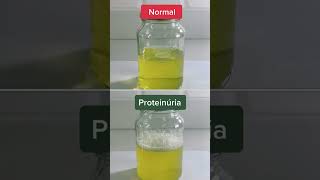 Normal Urine Vs Proteinuria Protein in Urine Differences [upl. by Eveleen]