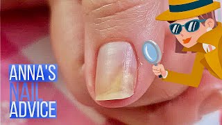 Nail Separation  Causes  Early Treatment of Onycholysis Annas Nail Advice [upl. by Nnawaj]