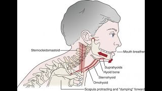 A common cause of TMD Suprahyoid muscle clenching [upl. by Atsylak]