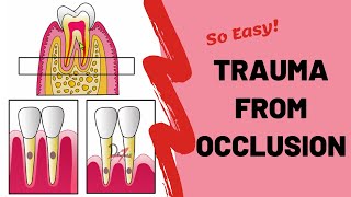 Trauma From Occlusion TFO  PERIODONTOLOGY [upl. by Nnaitak]