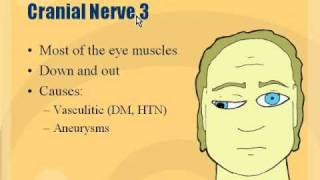 Neuro  Cranial Nerve 3 Palsy [upl. by Stutman]