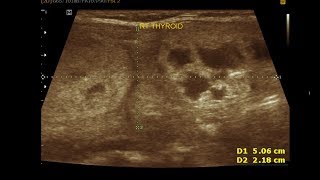 Ultrasound cases 312 of 2000  Multinodular adenomatous nodule Thyroid [upl. by Onida]