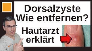 Mukoide Dorsalzyste OP oder andere Therapie Dr Kasten Hautmedizin in Mainz [upl. by Atnohs588]