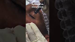 microdermalface microdermal piercing [upl. by Brothers617]