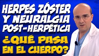 HERPES ZÓSTER Y NEURALGIA POSTHERPÉTICA  ¿Qué pasa en del cuerpo de las personas que las padecen [upl. by Orhtej]