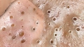 Best Pops of April 2022 Pimples Acne and Blackheads [upl. by Rozanna]