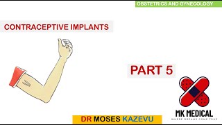 Subdermal implant contraceptives  Part 5 [upl. by Nylla]