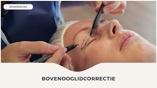 BOVENOOGLIDCORRECTIE ● FACELAND [upl. by Accebber272]