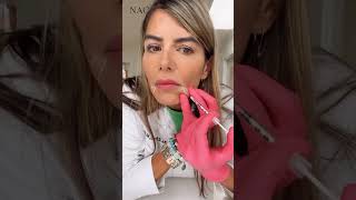 Injection for Downturned Mouth botox antiaging beauty fillers fillersinjection [upl. by Jourdain]