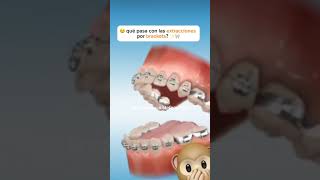 premolar extraction for orthodontic treatment ортодонтия kieferorthopädie ortodonzia orthodontie [upl. by Fine117]