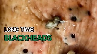 Blackheads Removal Acne Hidden For a Long Time [upl. by Nref]