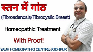 Breast Lump treatment । स्तन मे गाँठ का ईलाज ।fibroadenoma breast homeopathic treatment [upl. by Ludlew]