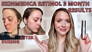 SKINMEDICA RETINOL HONEST REVIEW amp 3 MONTH RESULTS Is Medical Grade Skincare Worth It [upl. by Nylasoj]