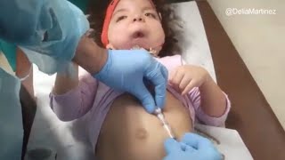 CAMBIO DE BOTON GASTRICO Con Cirujano Gástrico  GASTROSTOMIA [upl. by Michaelina437]