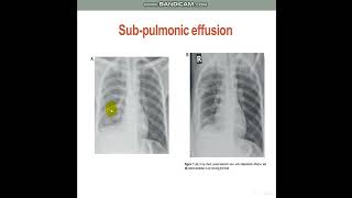 PleuralEffusionDiagnosticApproach [upl. by Marnie]