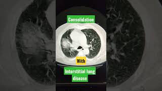 Interstitial Lung Disease viral youtubeshorts shorts [upl. by Pedaiah990]