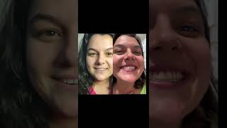 Tratamento com Invisalign  Ortodontia odontologia [upl. by Ecenahs]