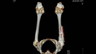 Subcapital femur neck fracture [upl. by Heisel]